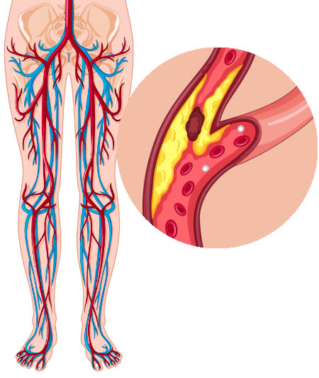 Damaged Artery